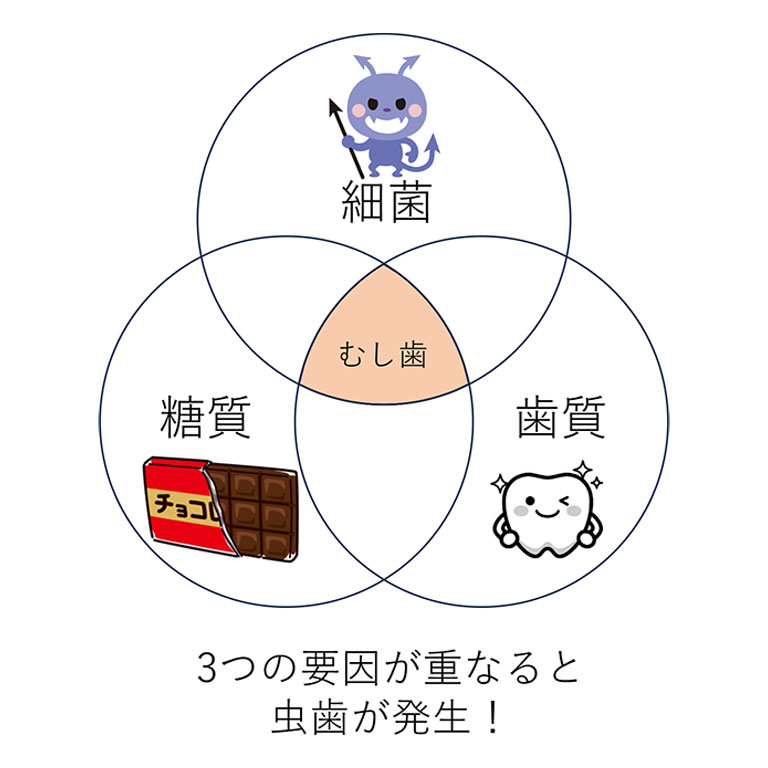 虫歯の3つの発生要因を示したイラスト