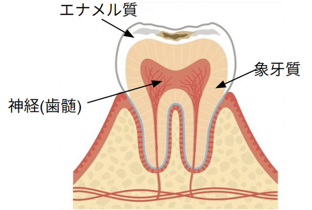 エナメル質の虫歯(C0.C1)