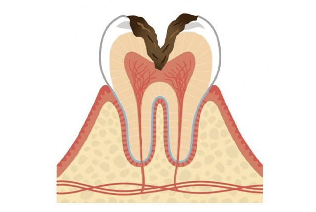 神経まで進行した虫歯(C3)