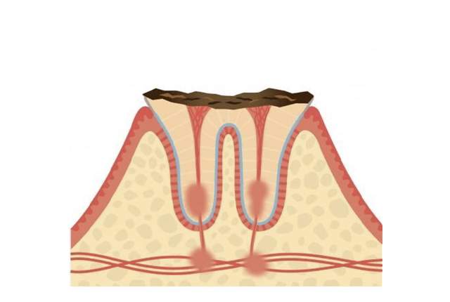 歯根だけ残った虫歯(C4)