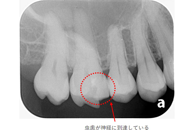 歯髄保存療法の治療例（Before）