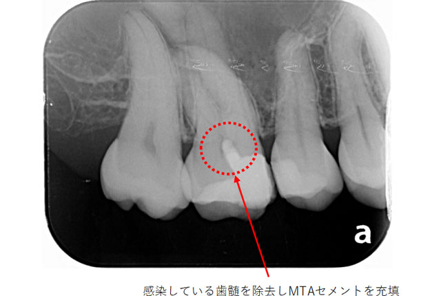 歯髄保存療法の治療例（After）