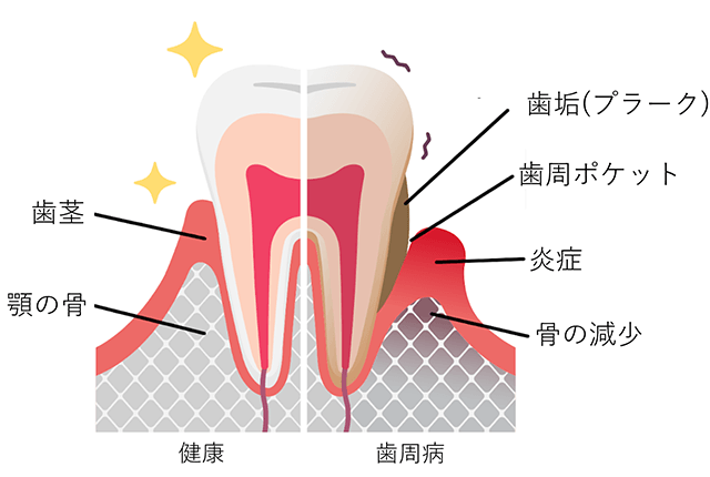 歯周病のイラスト