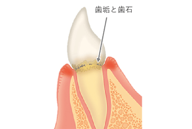 初期の歯周病(歯肉炎)