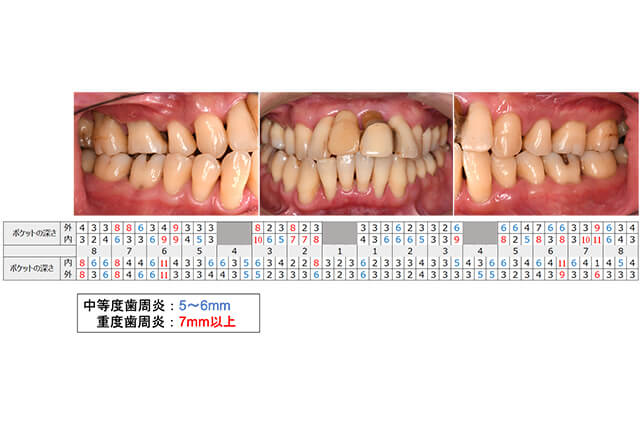 歯周病治療の症例（Before）