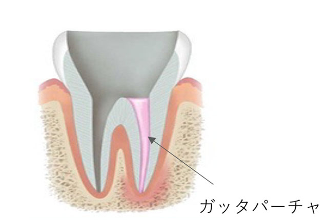 神経を取った後の空洞に、「ガッタパーチャ」という薬を詰めます