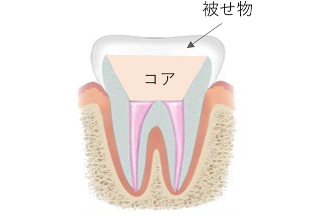 「コア」と呼ばれる土台を入れた後に被せ物をいれます