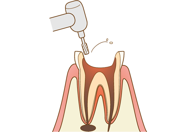 虫歯の除去