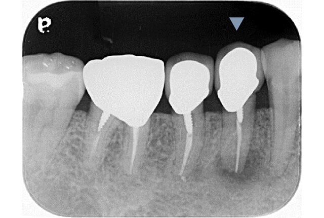 レントゲン画像（Before）