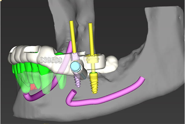 歯科用CT・口腔内スキャナーを用いた診断＆シミュレーション