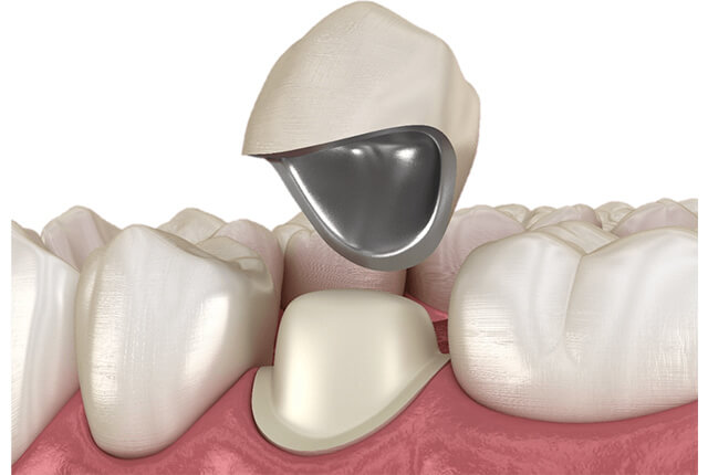 メタルセラミッククラウン