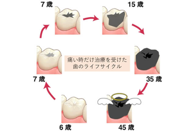 痛い時だけ治療を受けた歯のライフサイクル