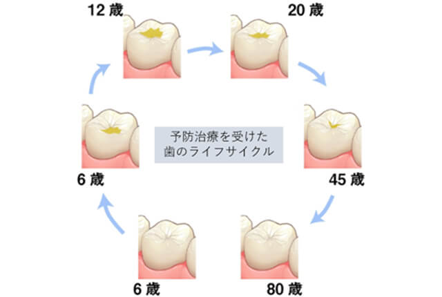 予防治療を受けた歯のライフサイクル