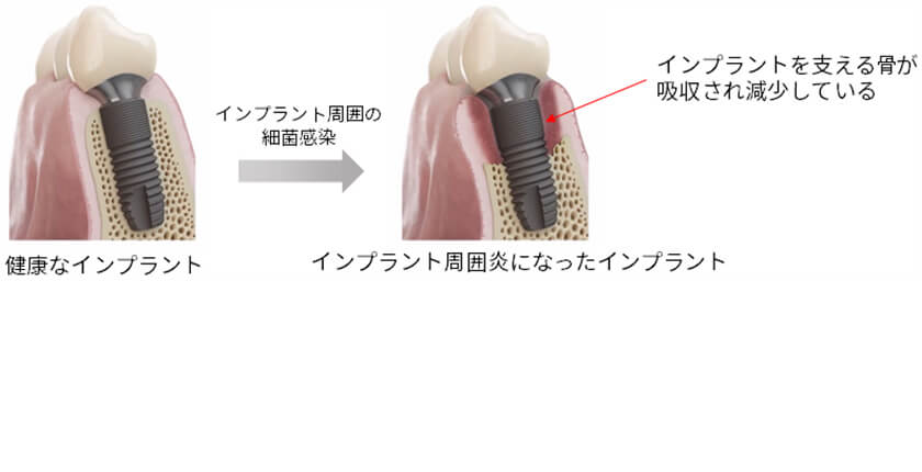 インプラント周囲炎になったインプラントのイラスト