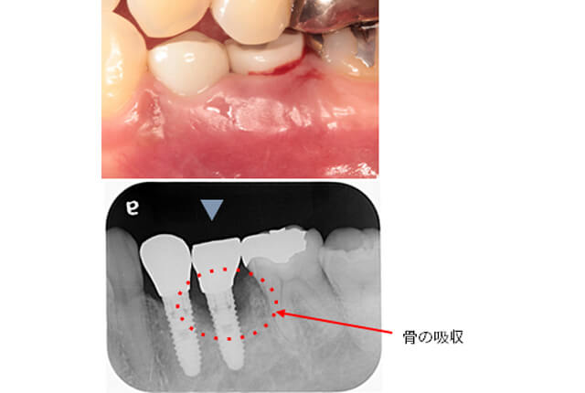 インプラント周囲炎治療例（Before）
