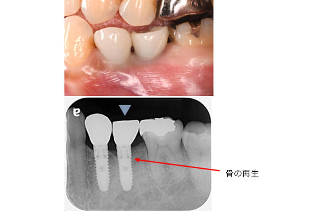 インプラント周囲炎治療例（After）