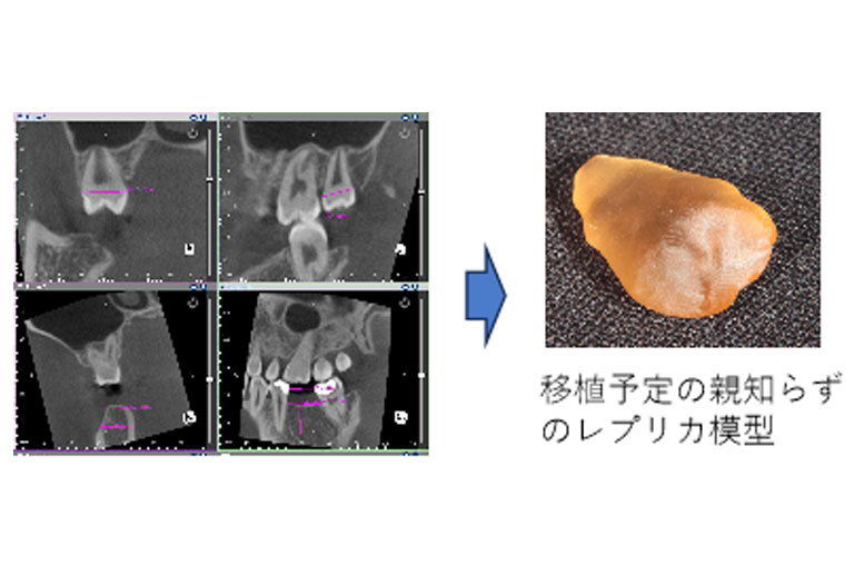 歯の移植 レプリカ 3Dプリンター