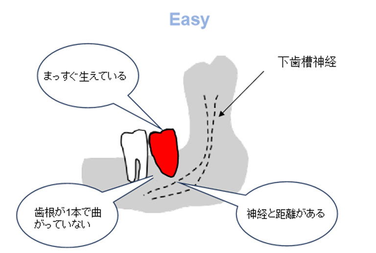 親知らず抜歯の難易度