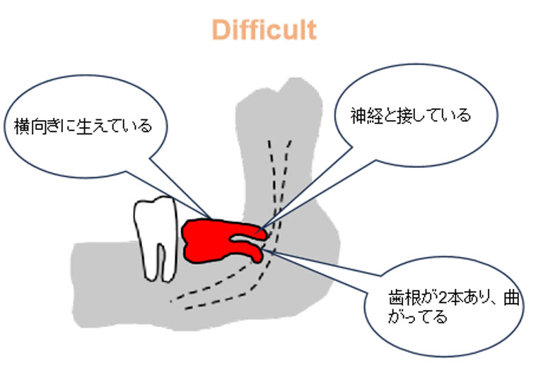 親知らず抜歯の難易度