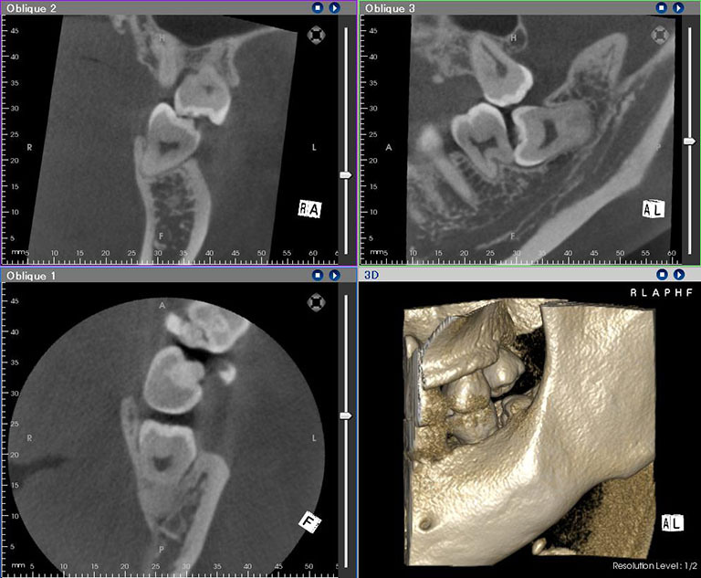 歯科用CTを用いた3D画像分析による安心・安全な抜歯