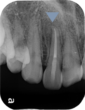 根管治療の症例 After