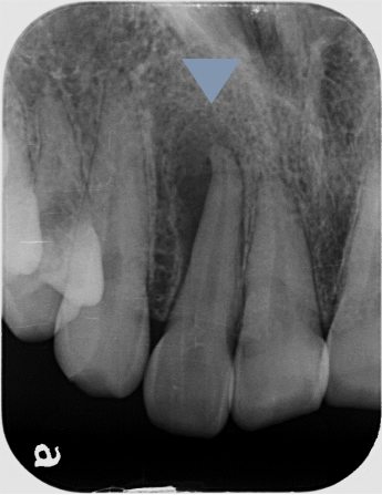 根管治療の症例 Before