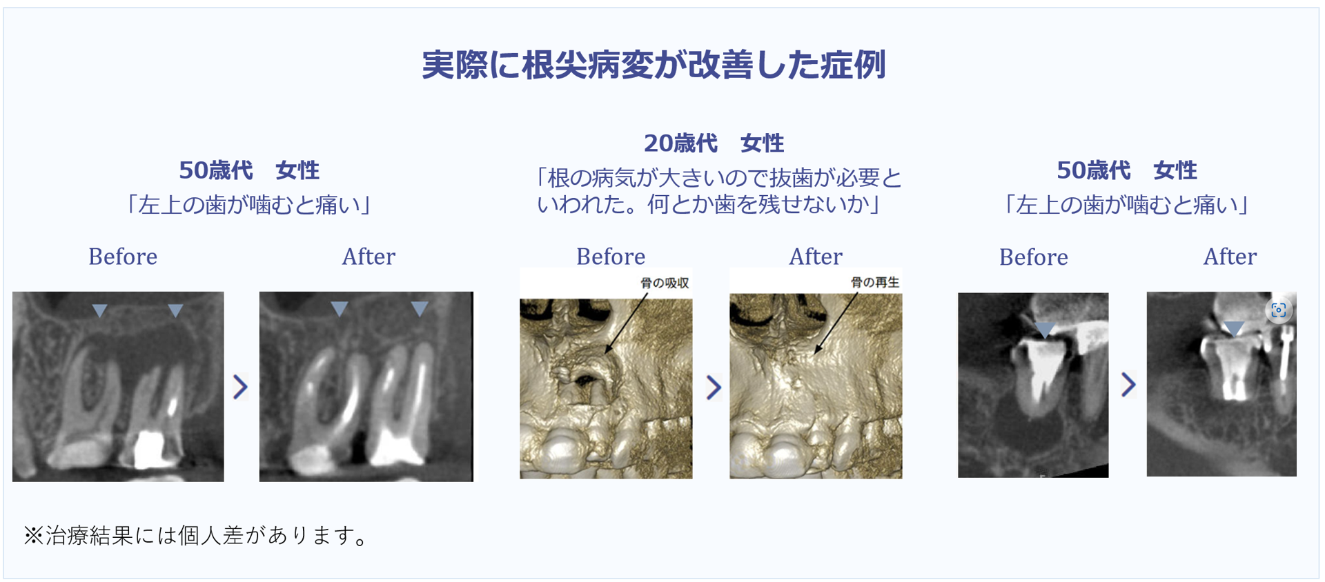 歯科医が解説】根尖病変は治る？？放置で自然治癒する？発生原因