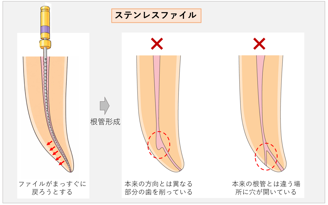 ステンレスファイルを用いると、湾曲根管では様々なトラブルが起こる可能性があるというイラスト