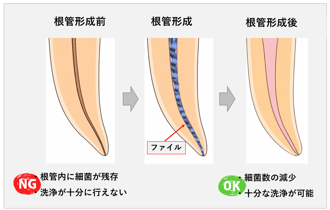 根管治療前・根管治療中・根管治療後の根管のイラスト