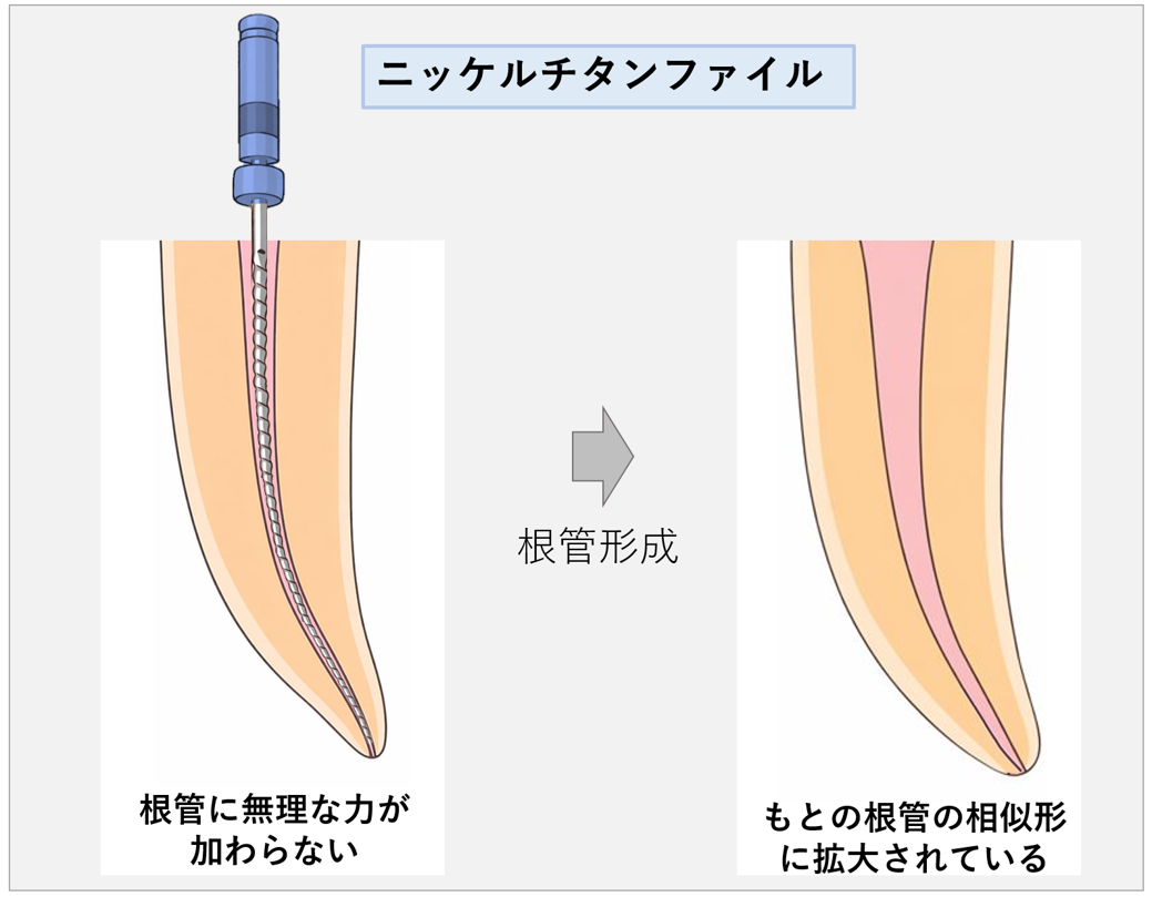 ニッケルチタンファイルでは根管の解剖学的形態が維持できますよというイラスト