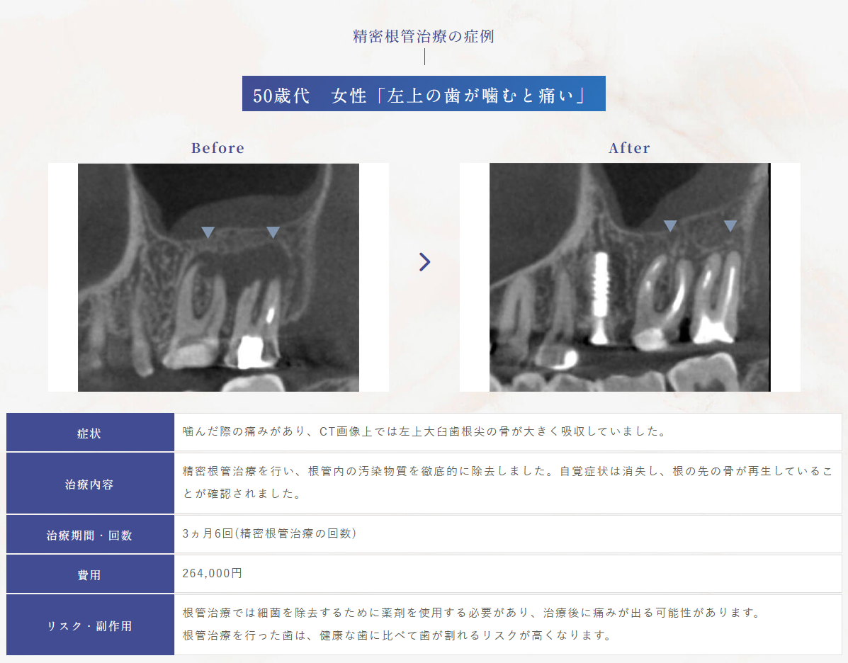 歯科医が解説】根尖病変は治る？？放置で自然治癒する？発生原因